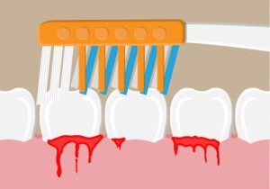 Toothbrush cleans teeth. periodontal disease, bleeding gums. Brushing teeth. Dental equipment. Hygiene and oralcare. Vector illustration in flat style
